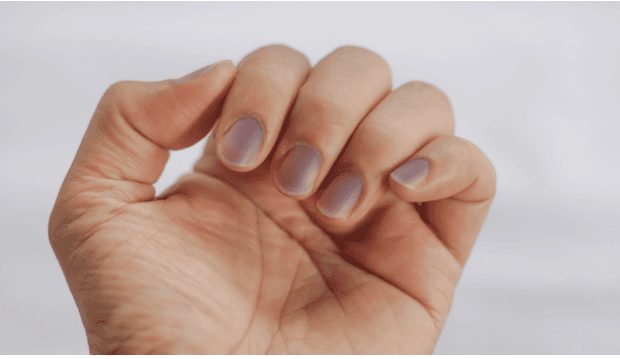 manchas azules en las uñas